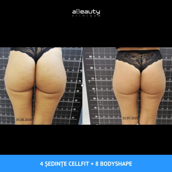 Tratament Anticelulită Puternic & Intensiv CellFIT, neinvaziv, ședință 40 minute - imagine 10