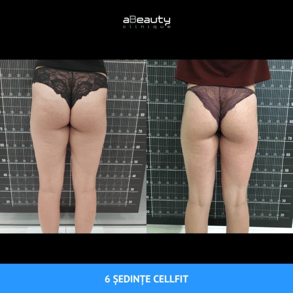Tratament Anticelulită Puternic & Intensiv CellFIT, neinvaziv, ședință 40 minute - imagine 9