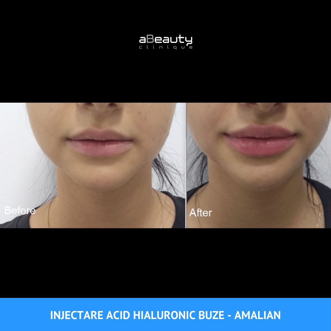 Rejuvenarea și remodelarea facială cu acid hialuronic. Augmentarea buzelor cu acid hialuronic.