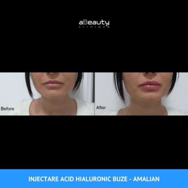 Rezultate Injectare Acid Hialuronic Marire Buze 16