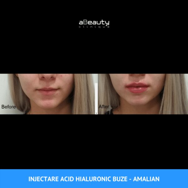 Rezultate Injectare Acid Hialuronic Marire Buze 17