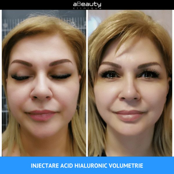 Injectare Toxină Botulinică Riduri Vistabel, 1 flacon x 50 de unități botox - imagine 7
