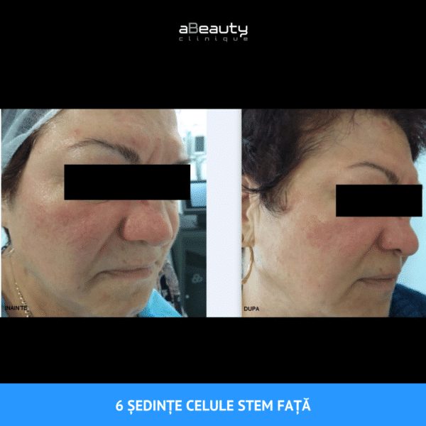 Ședință de tratament facial cu Celule Stem pentru anti-aging, anti-riduri, anti-pete pigmentare, anti-cearcăne și anti-roșeață - imagine 13