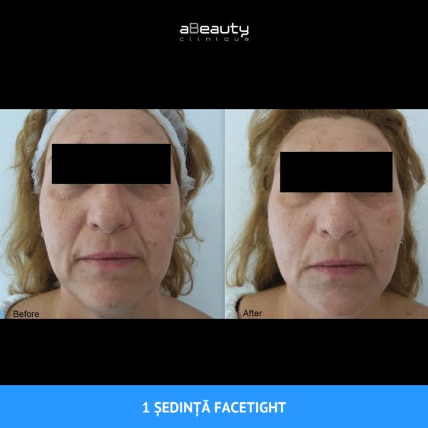 Pachet 2 ședințe, Tratament Facial Întinerire și Fermitate FaceTight, neinvaziv, Zona Submandibulară - imagine 15