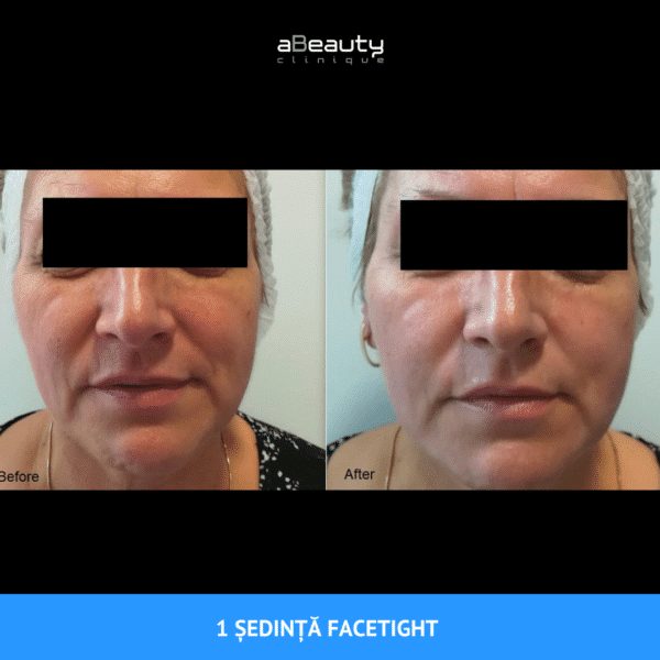 Pachet 2 ședințe, Tratament Facial Întinerire și Fermitate FaceTight, neinvaziv, Zona Submandibulară - imagine 13