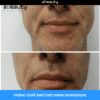Injectare Toxină Botulinică Riduri Vistabel, 1 flacon x 50 de unități botox - imagine 8