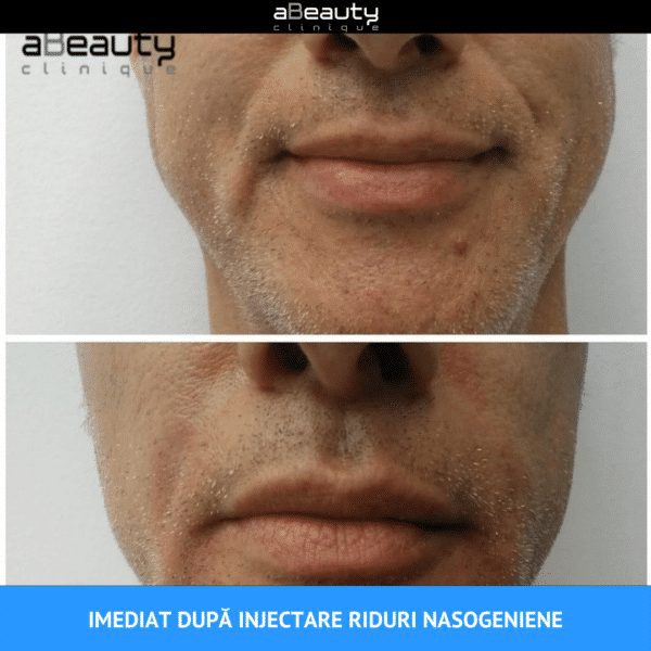 Injectare Toxină Botulinică Riduri Vistabel, 1 flacon x 50 de unități botox - imagine 8