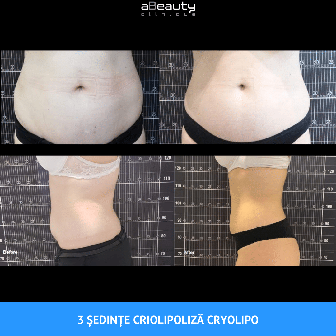 tratament slabit abdomen