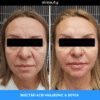 Injectare Toxină Botulinică Riduri Vistabel, 1 flacon x 50 de unități botox - imagine 5