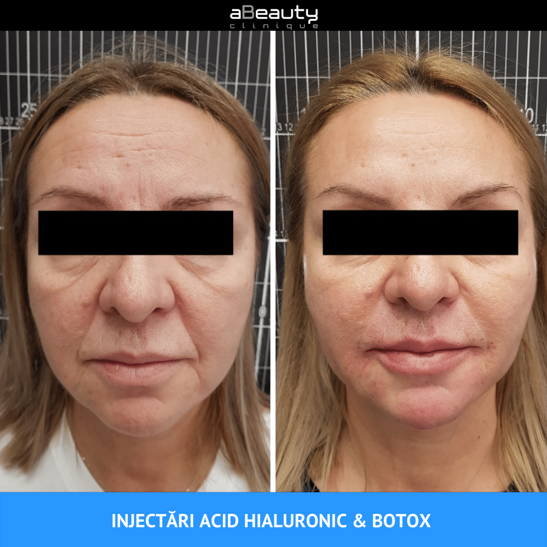 botox riduri frunte pret