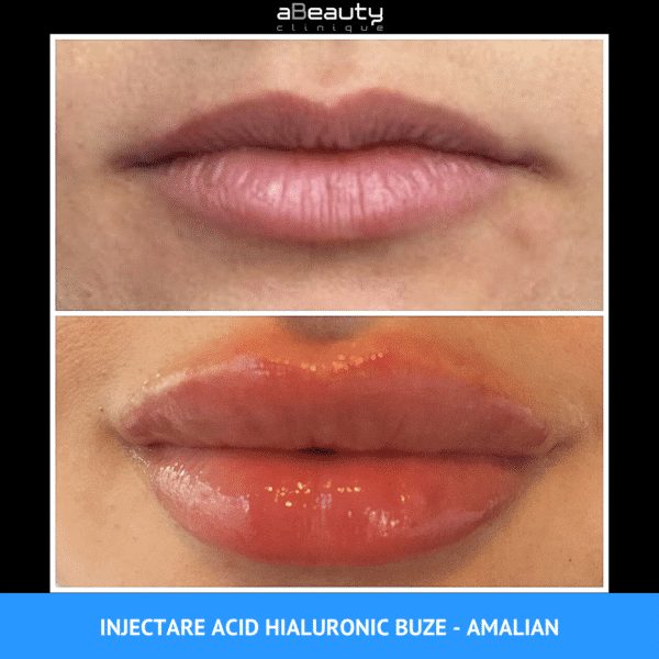 Rezultate Injectare Acid Hialuronic Marire Buze 4