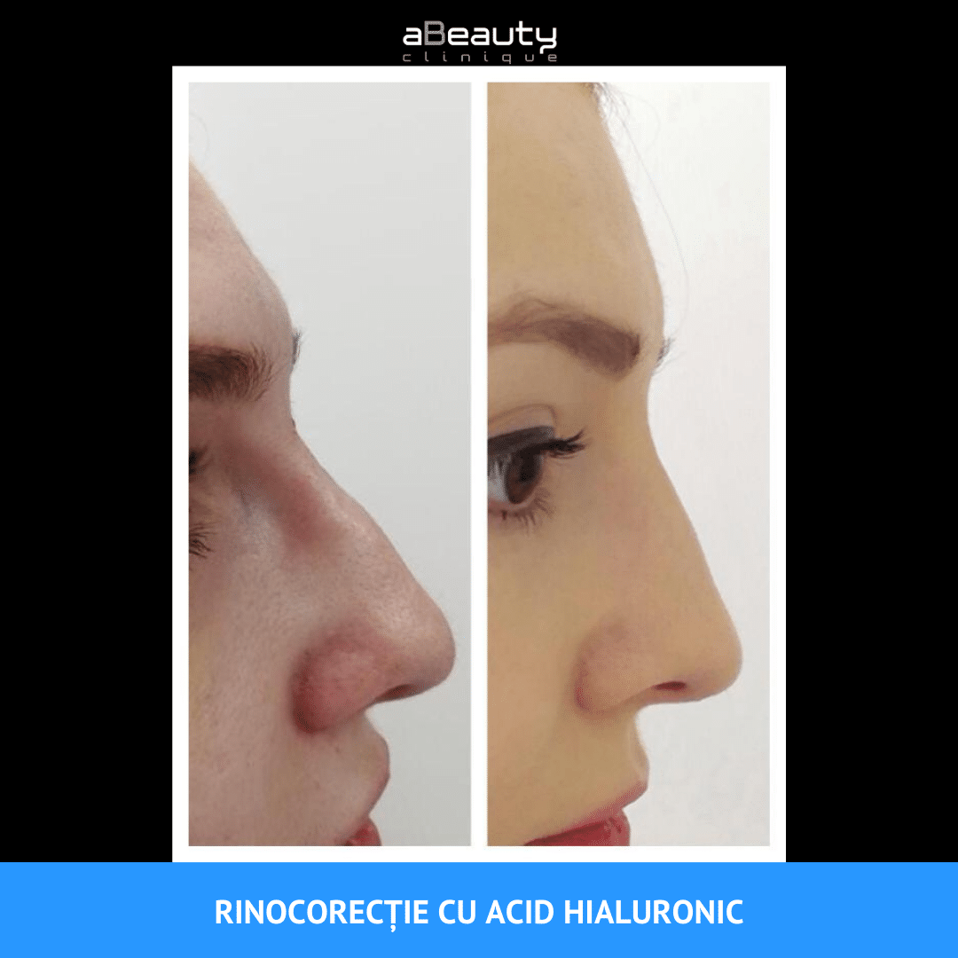 Injectii cu acid hialuronic pentru tratarea ridurilor | SKiN MedSpa