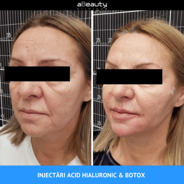 Injectare Toxină Botulinică Riduri Vistabel, 1 flacon x 50 de unități botox - imagine 6