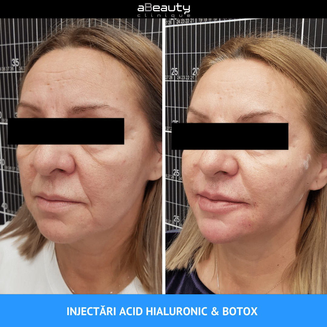 Botox pentru slăbirea instantanee a feței Jawline cu injecții cu Botox