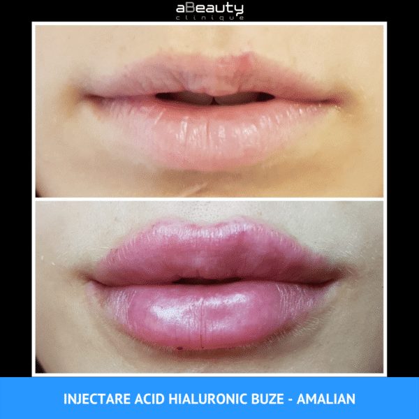 Rezultate Injectare Acid Hialuronic Marire Buze 6