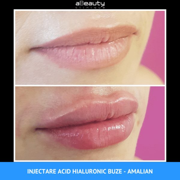 Rezultate Injectare Acid Hialuronic Marire Buze 7