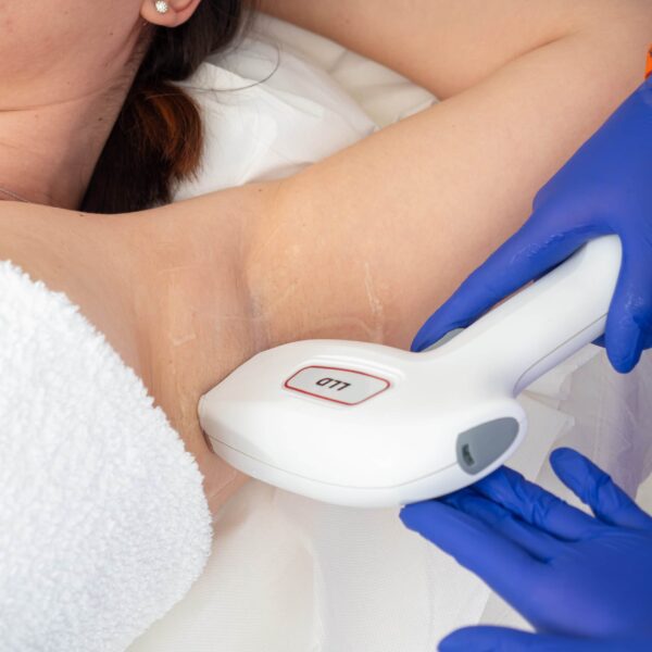 Epilare Laser 2.0, Detecție Melanină și Calibrare Automată, ședință Axile