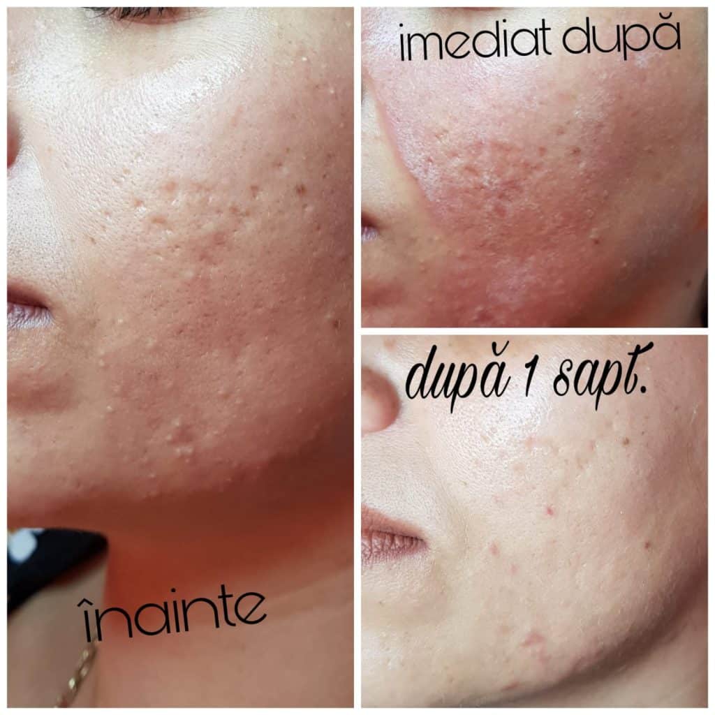 Rezultate Peeling Chimic