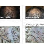 Tratament cu celule Stem alopecie si cadere par