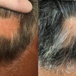 Tratare alopecie barbati - Tratament par cu celule Stem