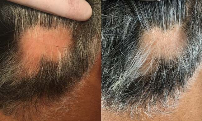 Tratare alopecie barbati - Tratament par cu celule Stem