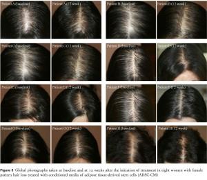 Tratare alopecie femei - Tratament calvitie cu celule Stem