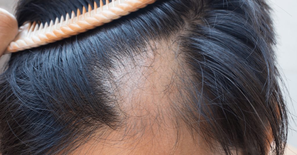 Calvitie-vs-Alopecie