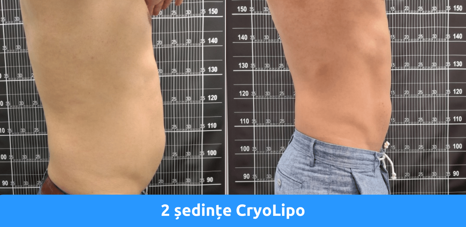 Rezultate criolipoliza
