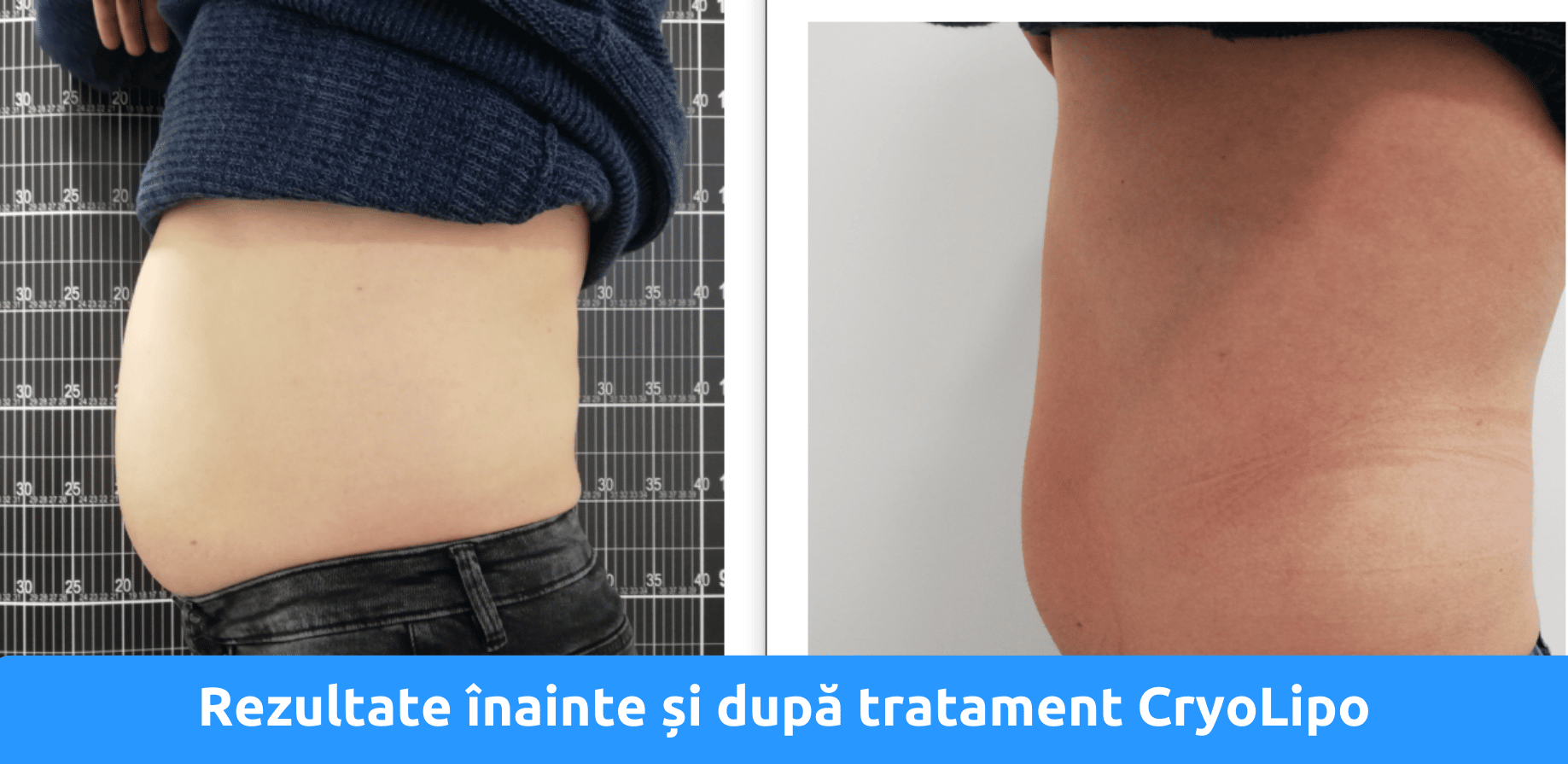Rezultate criolipoliza