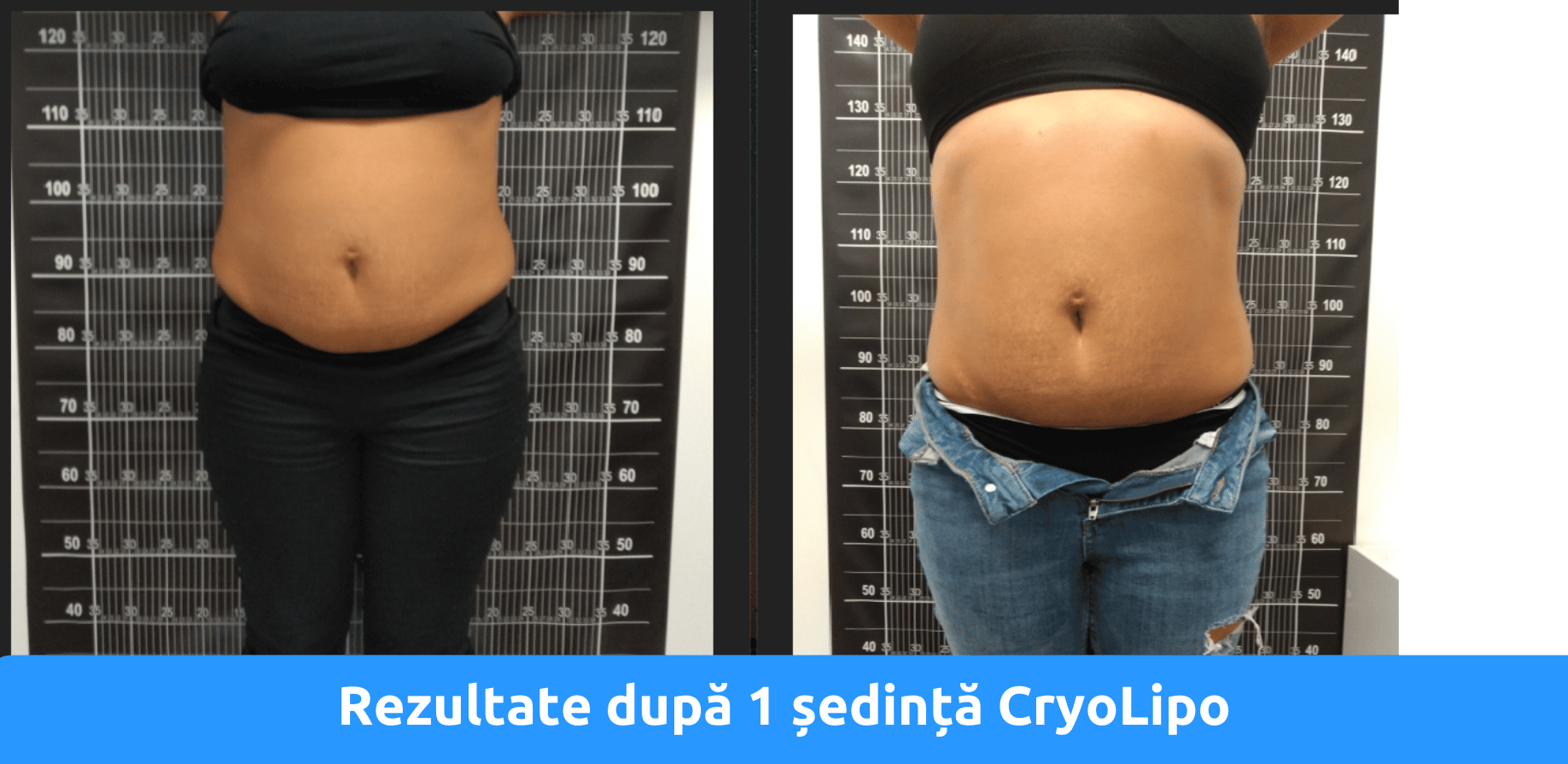 Rezultate criolipoliza
