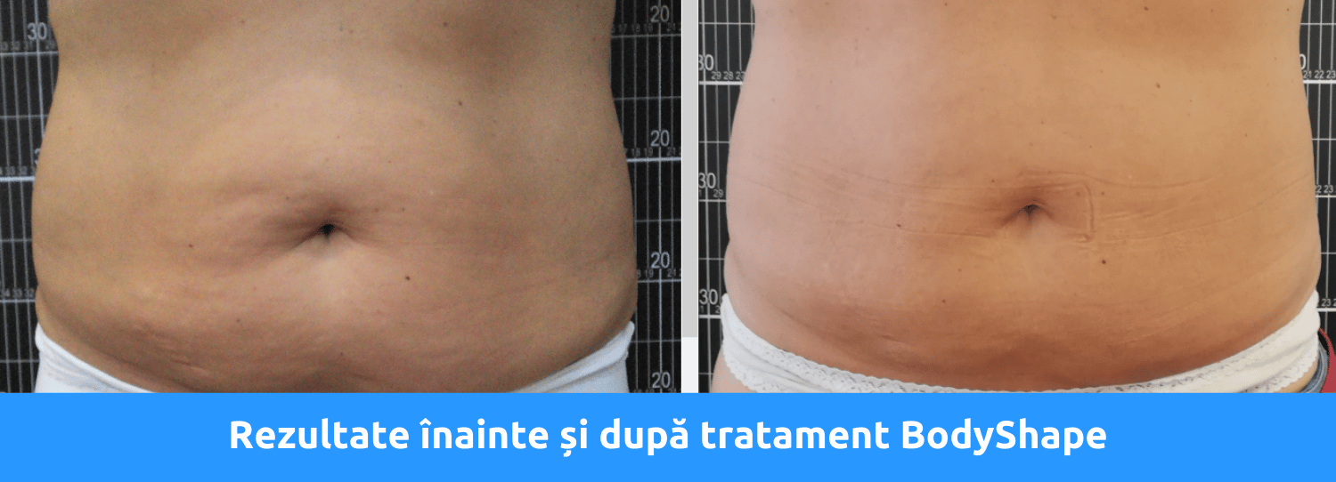 Rezultate Bodyshape