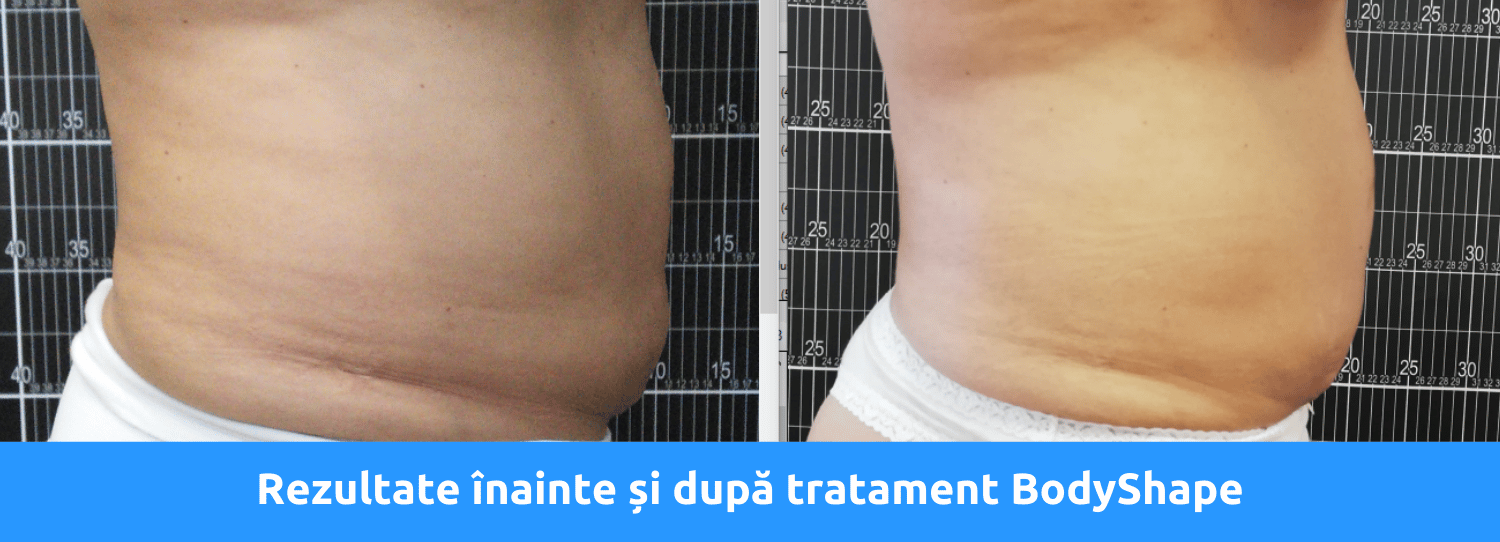 Rezultate Bodyshape