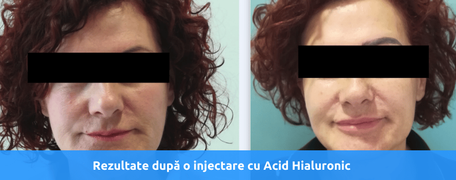 rezultate acid hialuronic