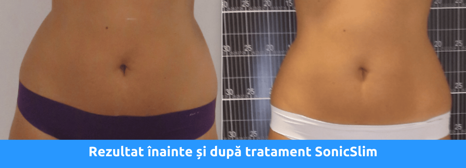 rezultate sonicslim