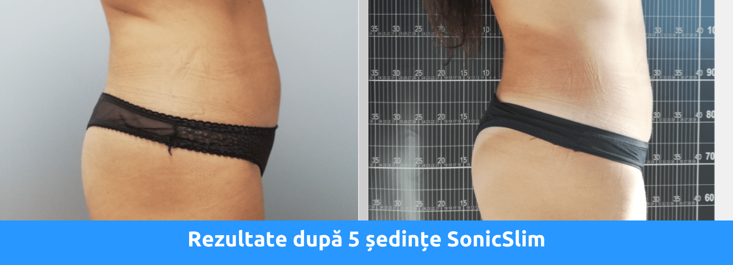 rezultate sonicslim