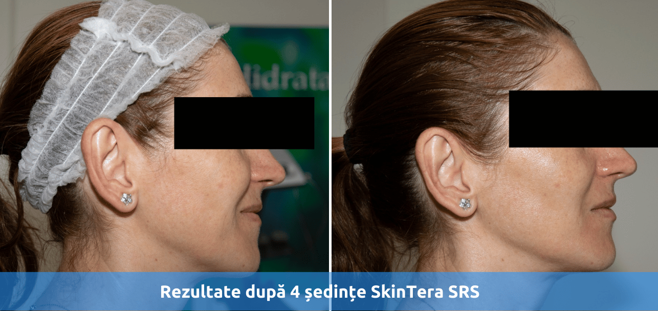 Rezultate după 4 ședințe SkinTera SRS