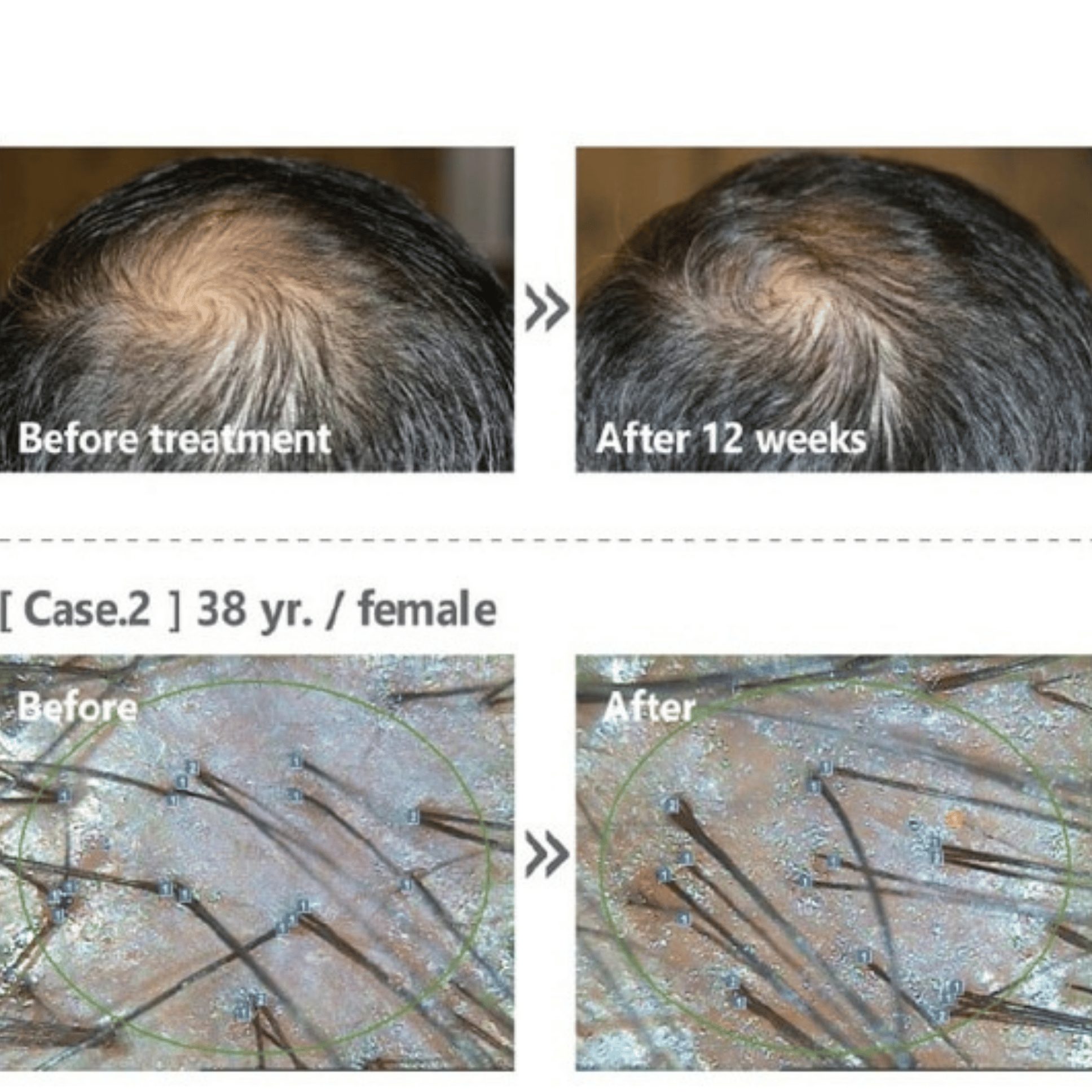 rezultate tratament alopecie