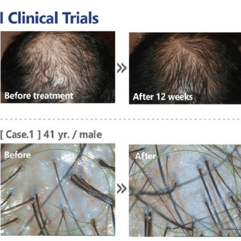 tratament alopecie