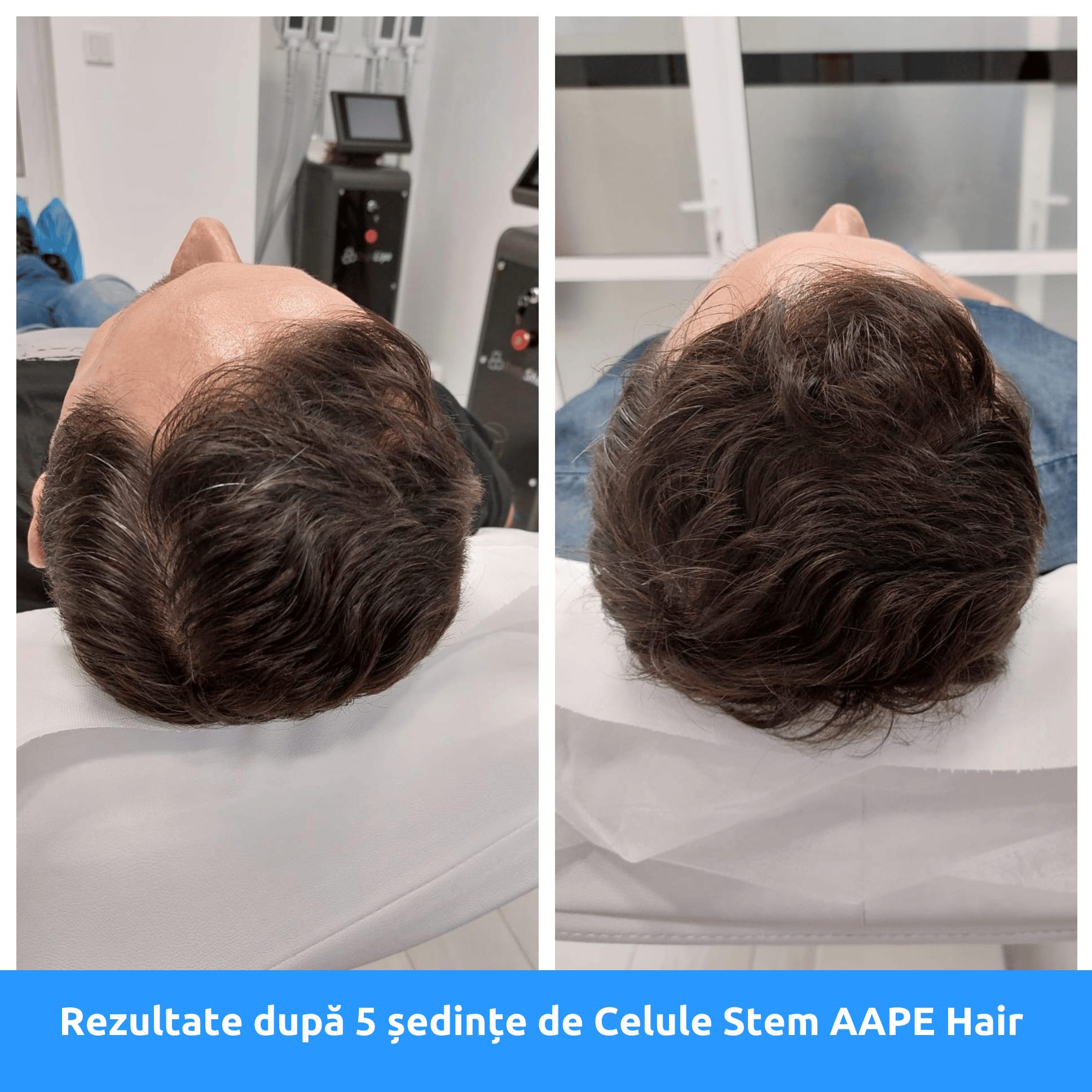 tratament celule stem păr bărbați