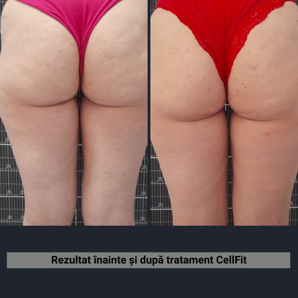 Rezultate CellFit