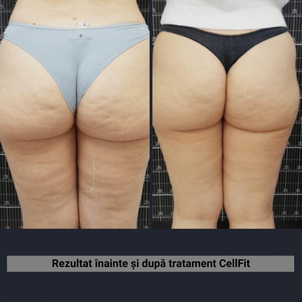 Rezultate CellFit