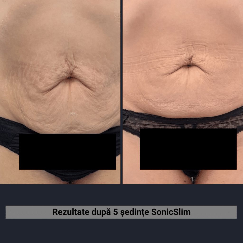 Rezultate SonicSlim