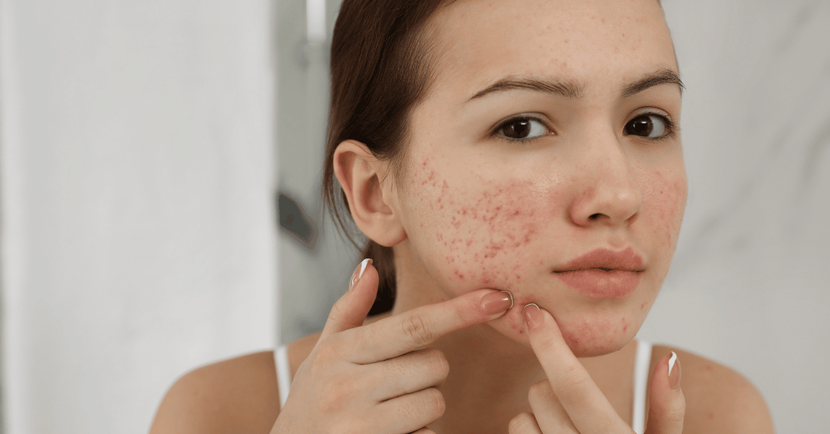 Ce este acneea și cum se poate trata