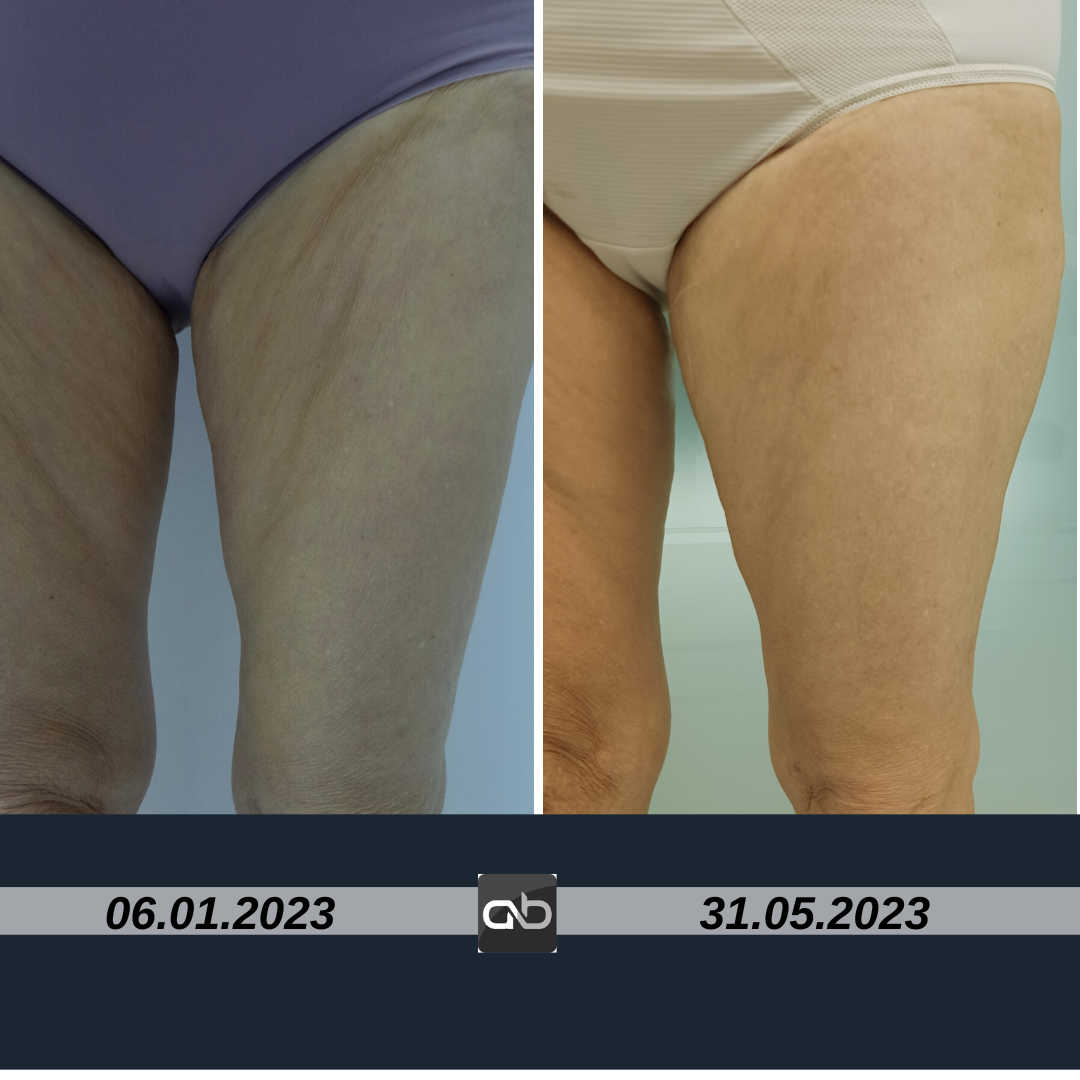 Tratament piele lăsată SonicSlim