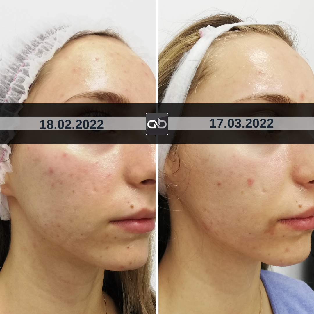 tratament facial mezoterapie