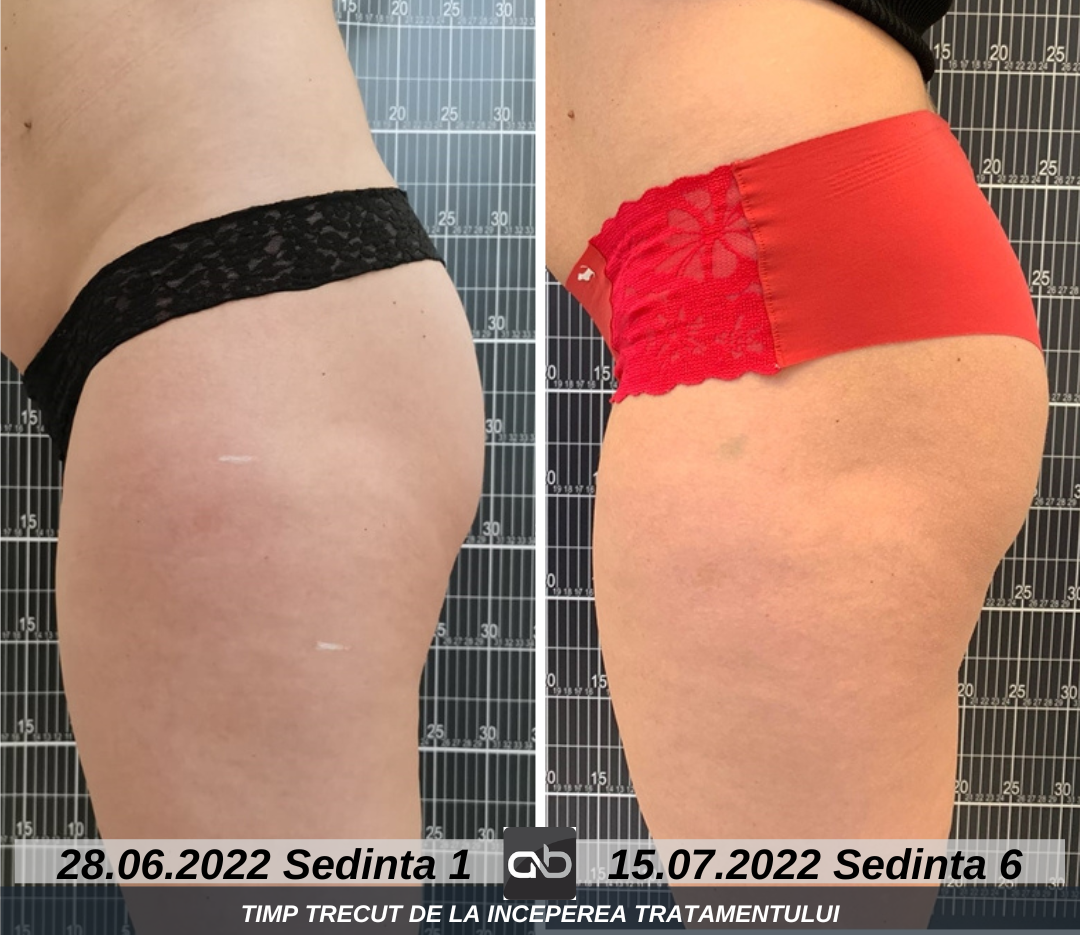 tratament tonifiere musculara DualFit