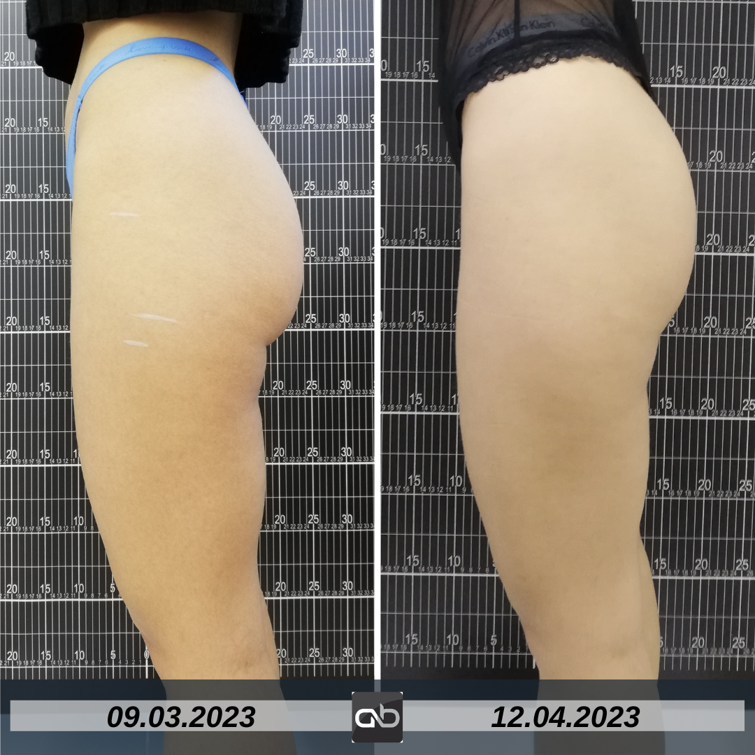 tratament tonifiere musculara DualFit