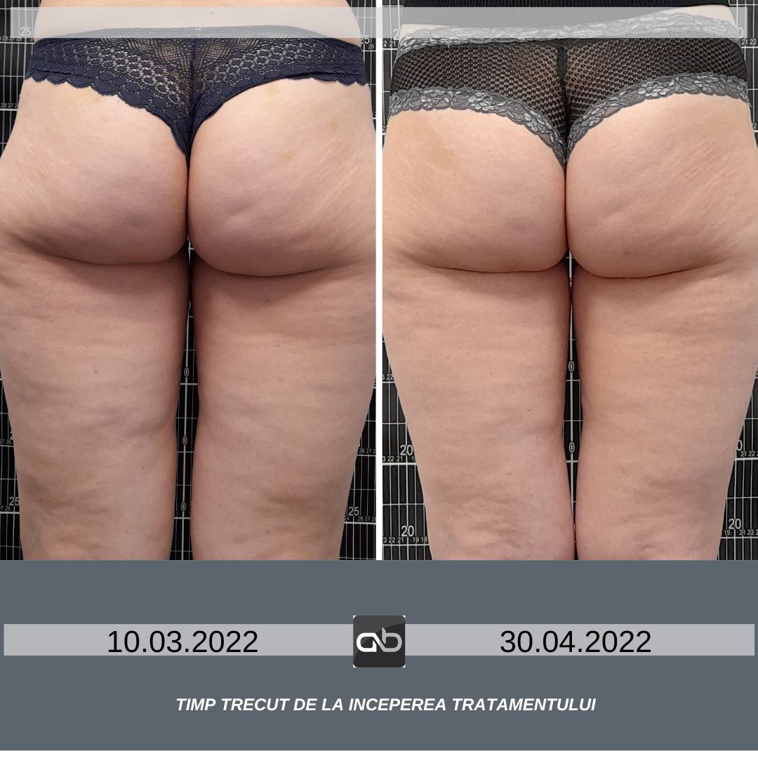 tratament anticelulita CellFit