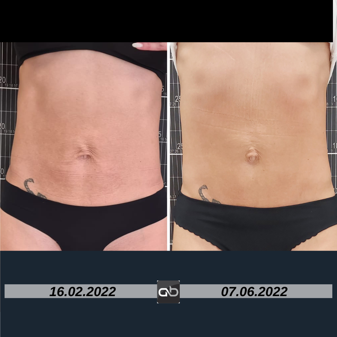 Tratament piele lăsată SonicSlim