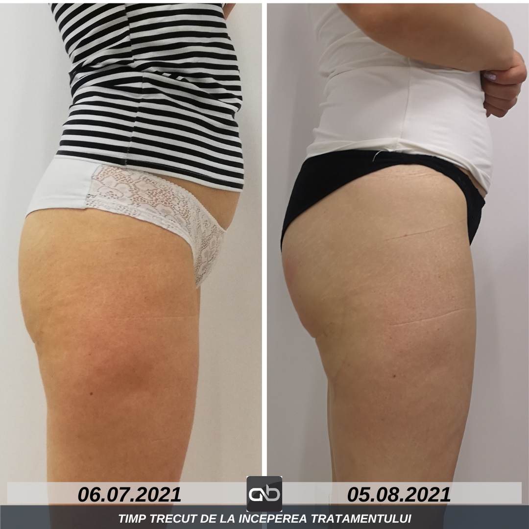tratament tonifiere musculara DualFit